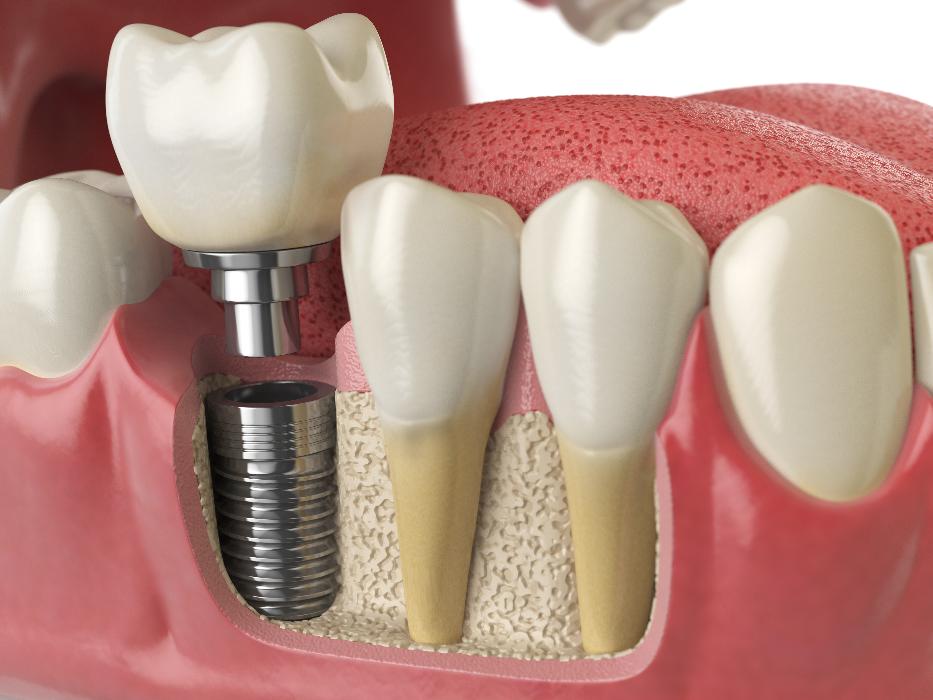 close up of dental implant in jaw | dental implants fishers in
